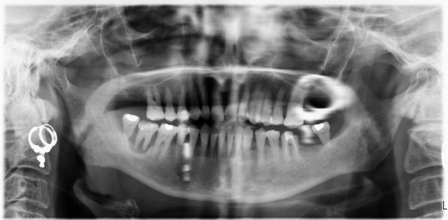 Orthopantomogram showing existing dentition including number of coronal restorations and severity of periodontal disease