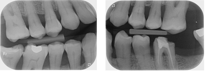 Left and Right Horizontal Bitewings showing existing dentition, note the generalised horizontal bone loss including furcation involvement.
