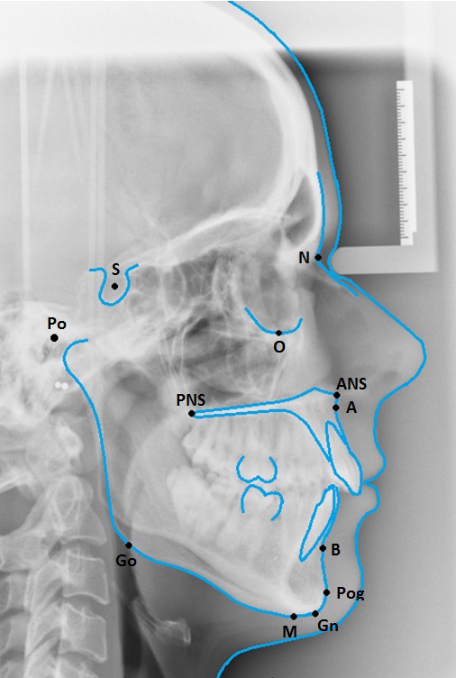 A Beginners Guide To Lateral Cephalometric Radiographs