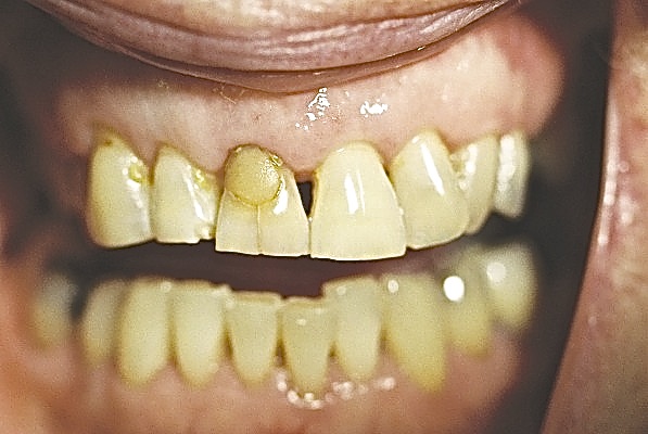 Rotten tooth Tooth