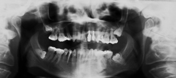 third-molars